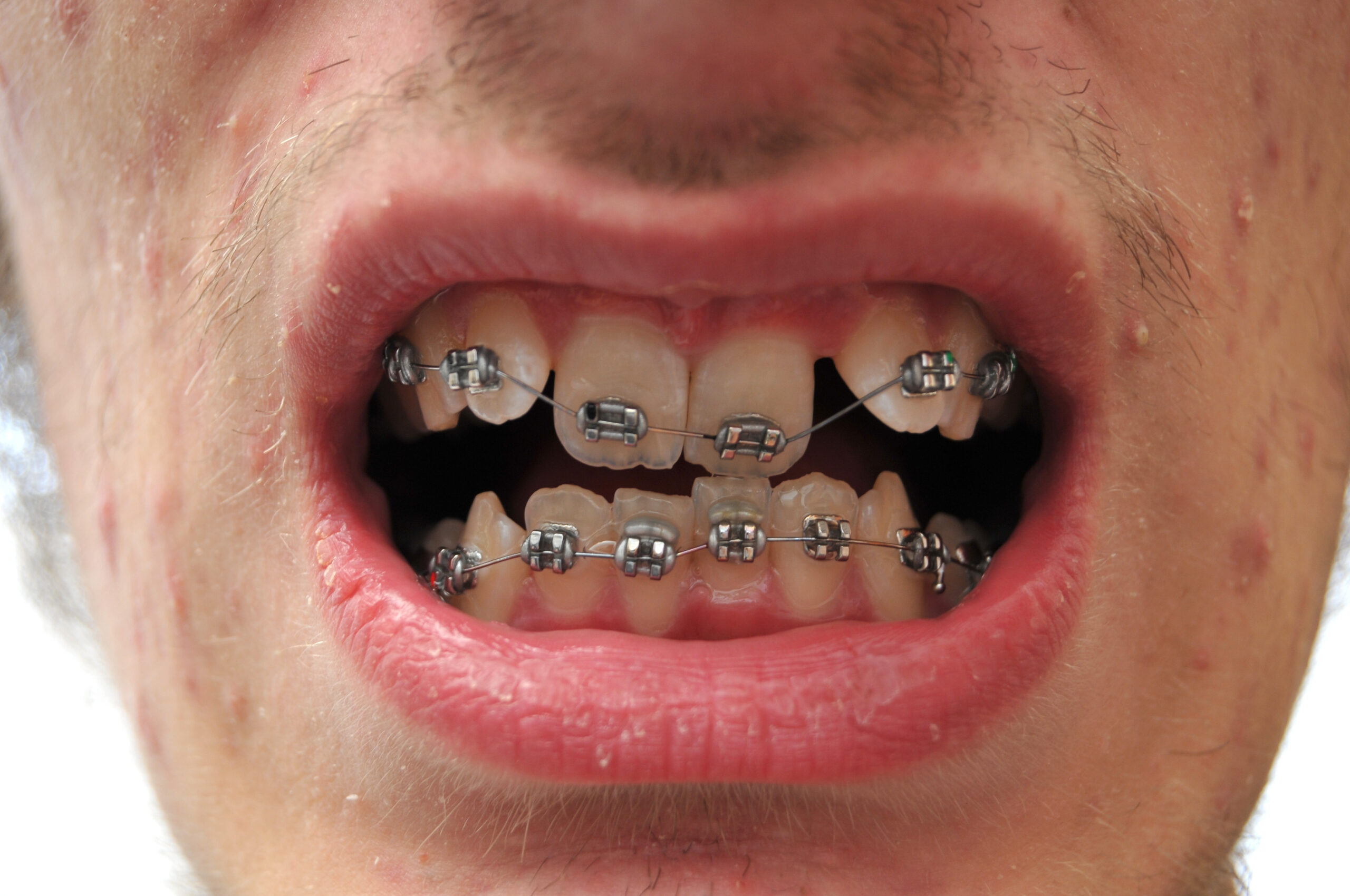 What Causes Craze Lines on Front Teeth?